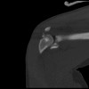 SPORK, NICO - 22.03.1976 - 02.08.2022 - CT obere Extremität - 17:59:07